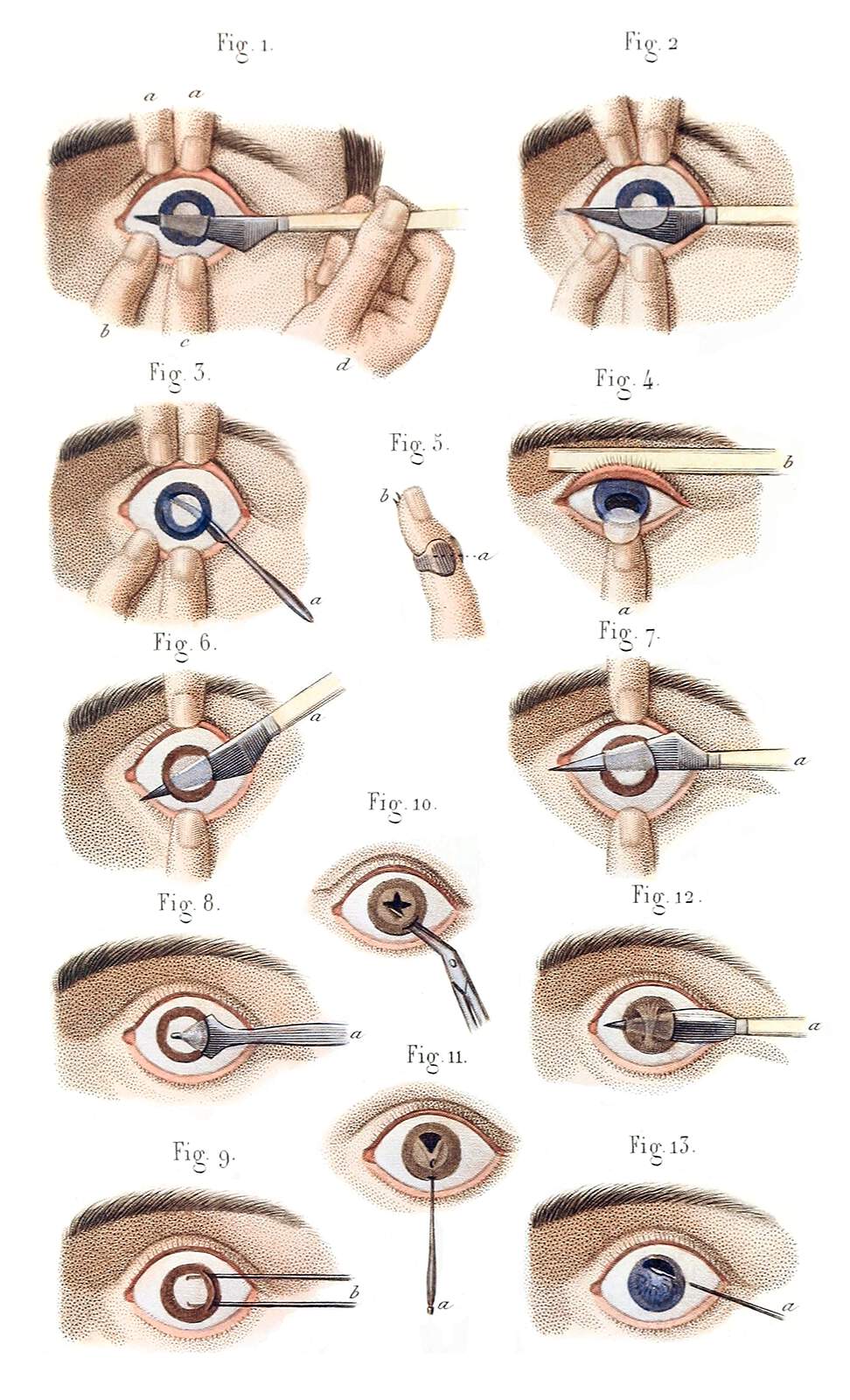 Cataract And Artificial Pupil Old Book Illustrations